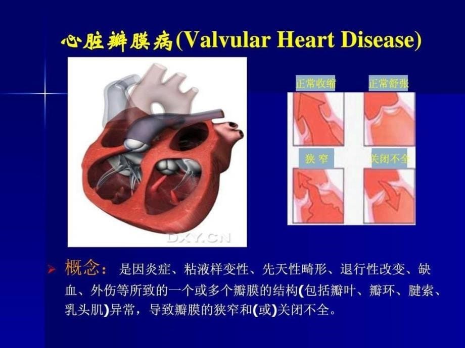 二尖瓣狭窄microsoft powerpoint 演示文稿图文课件_第5页