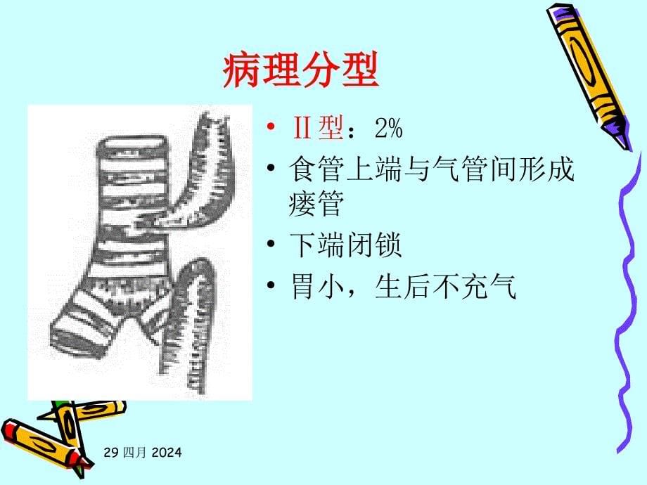 先天性食管闭锁围手术期护理讲述课件_第5页