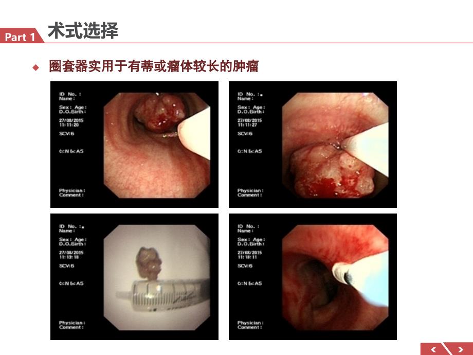 气管肿瘤介入治疗体会气管镜课件_第3页