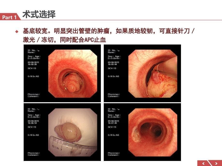 气管肿瘤介入治疗体会气管镜课件_第5页