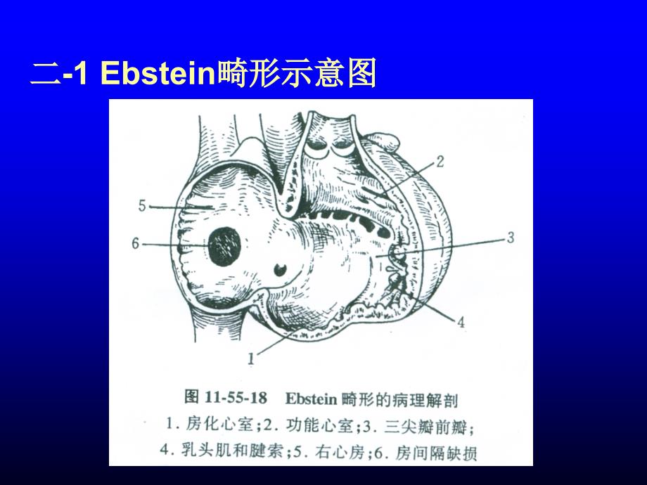 三尖瓣下移畸形课件_第4页