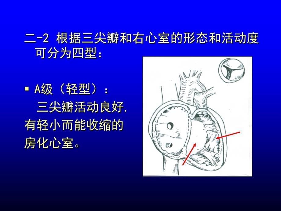 三尖瓣下移畸形课件_第5页