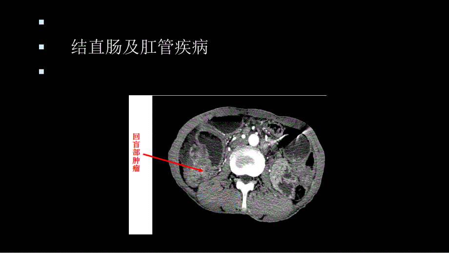 结直肠肛管解剖特色痔疮肛裂优质文档课件_第1页