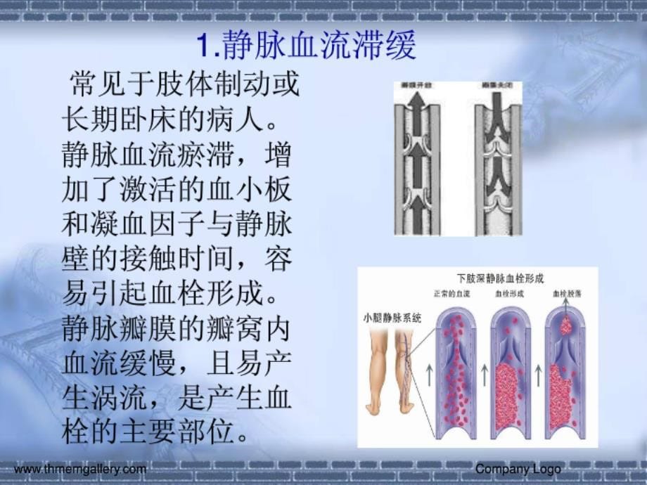 下肢静脉血栓的预防及护理课件_第5页