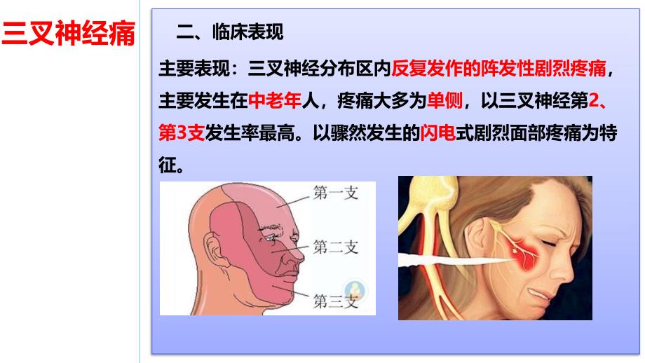 三叉神经痛病人的护理ppt课件_第3页