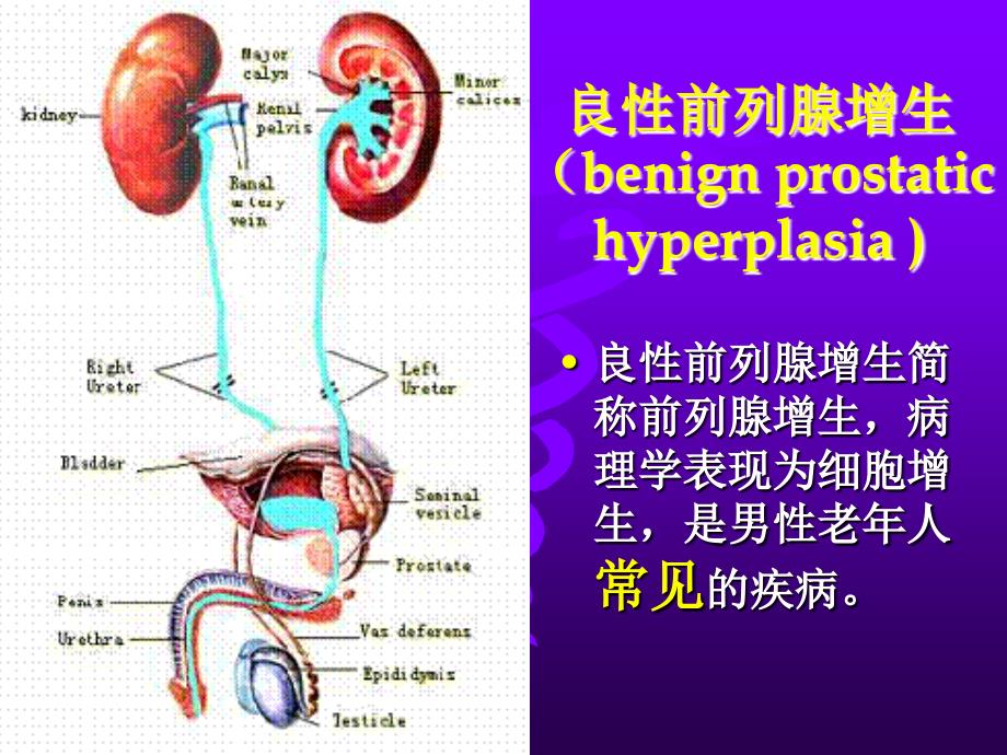 前列腺增生课件_3_第2页