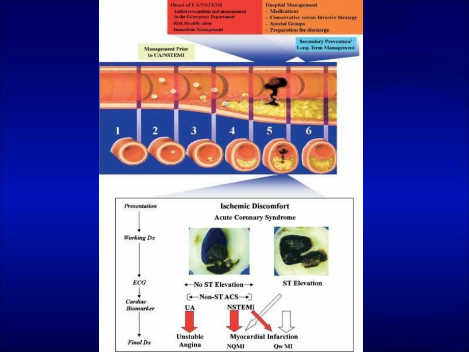不稳定性心绞痛和nstemi新建议课件_第3页