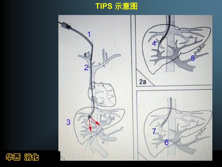 生物医学肝硬化门脉高压的介入治疗（四川大学华西医院消化内科唐承薇）课件_第4页