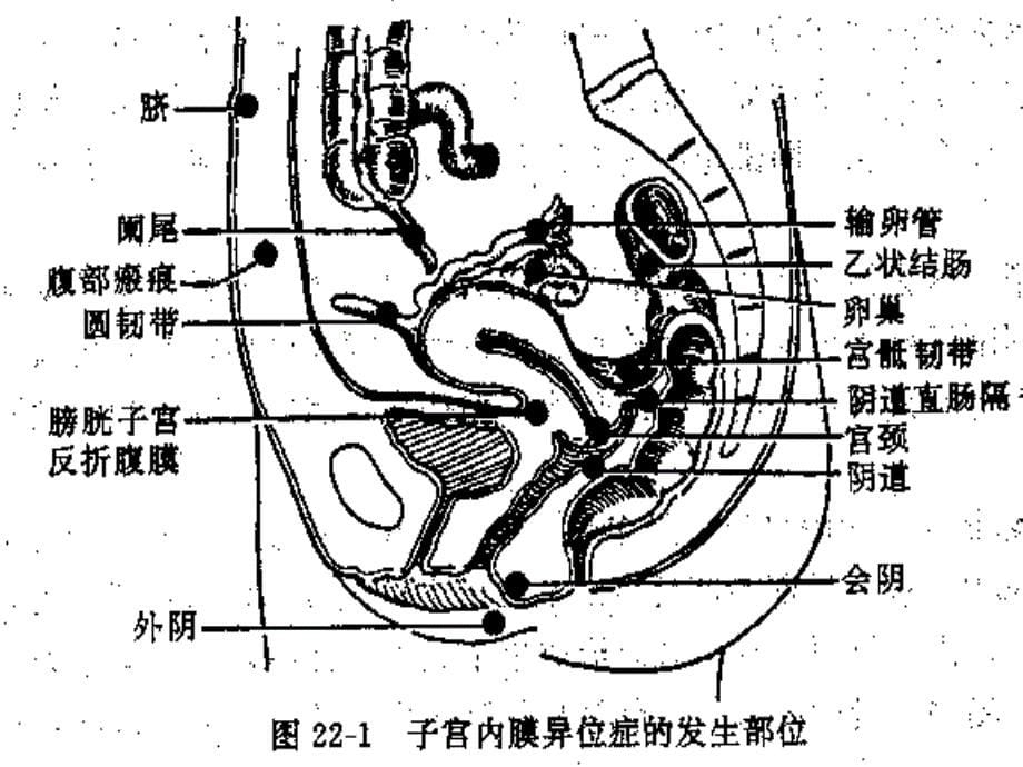 你知道子宫内膜异位症和子宫腺肌病有什么区别吗课件_第5页