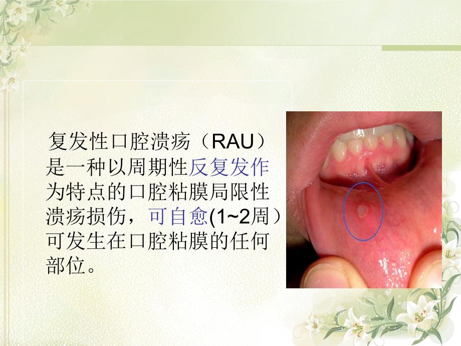 心身医学 口腔溃疡图文课件_第3页