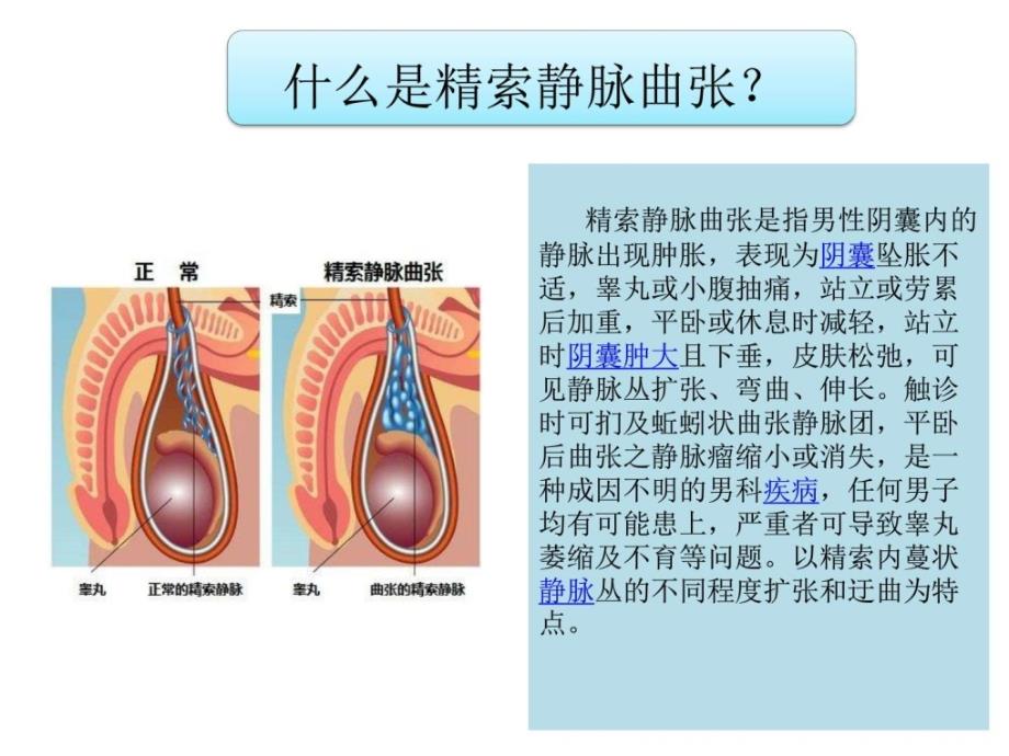 哪些精索静脉曲张需要手术治疗图文课件_1_第3页