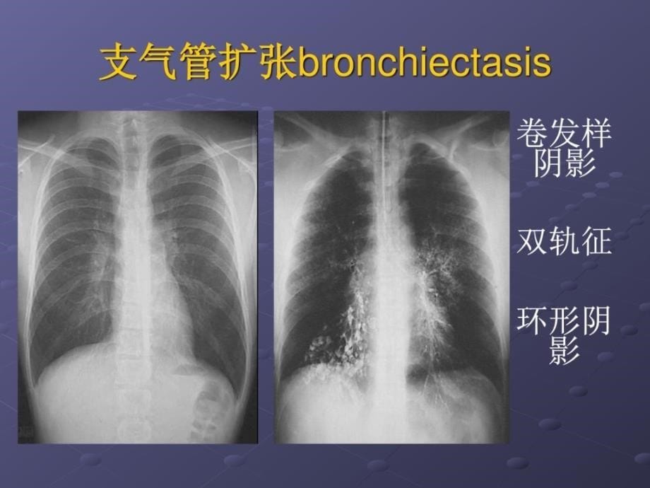 支气管扩张症心律失常课件_第5页