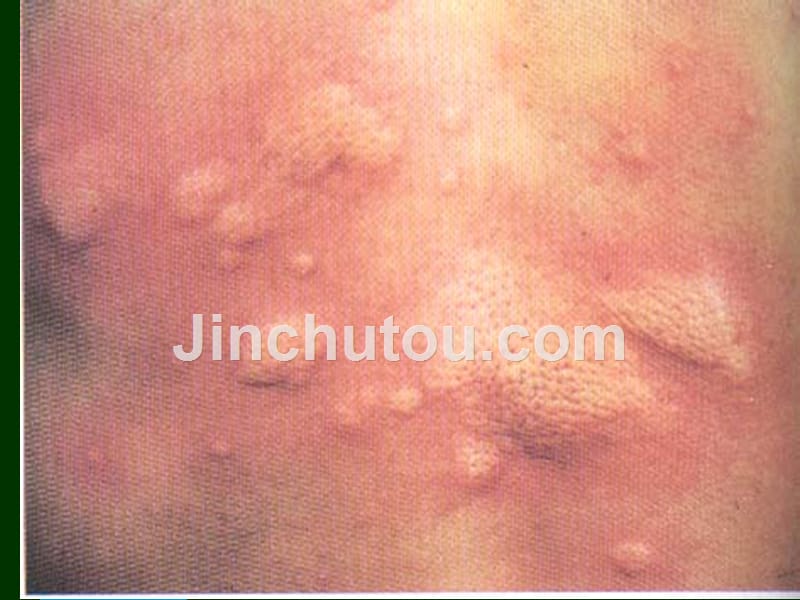 荨麻疹（urticaria）课件_第2页