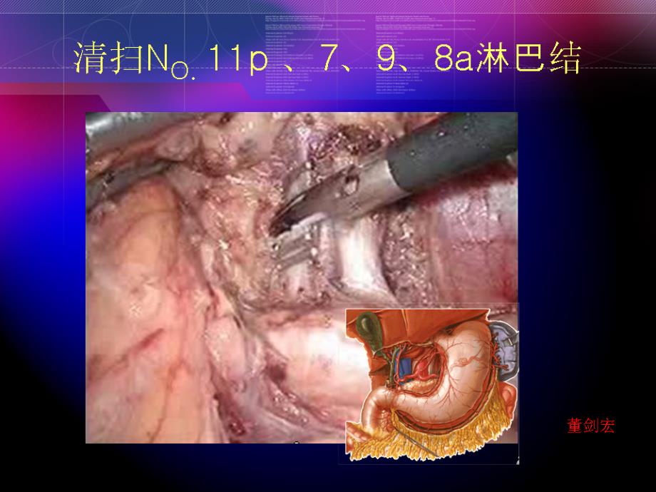 腹腔镜胃癌根治术（董剑宏）课件_第3页