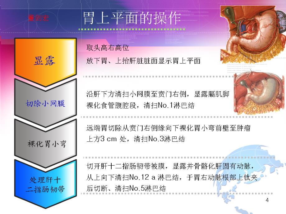 腹腔镜胃癌根治术（董剑宏）课件_第4页