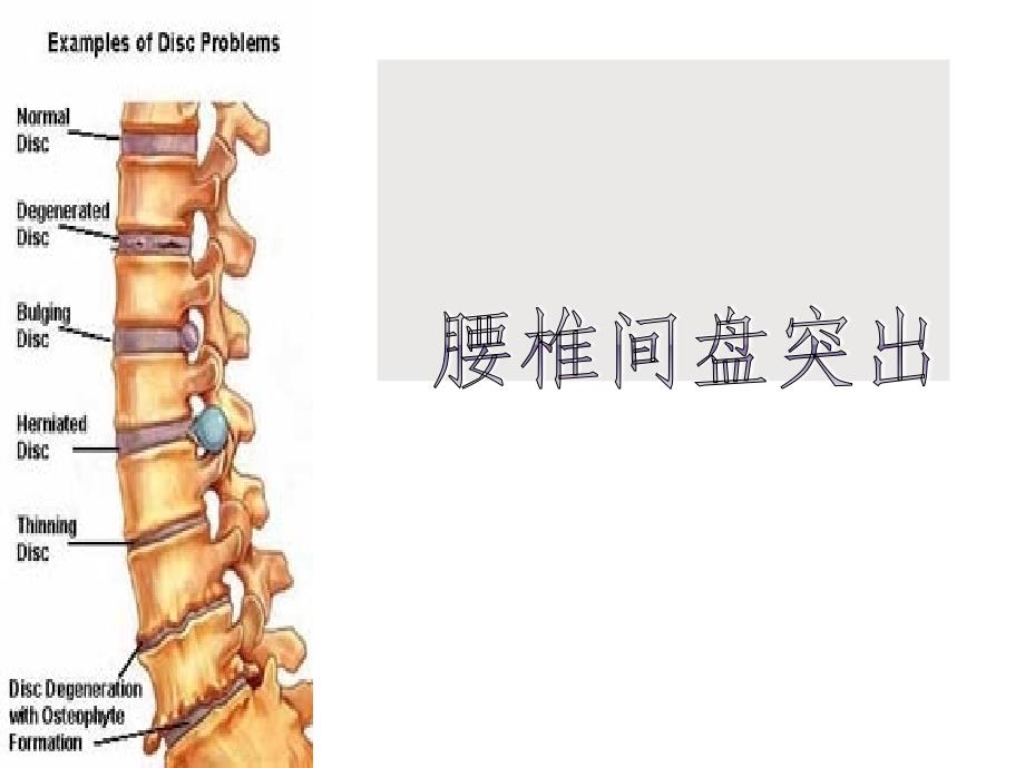 （腰椎间盘突出与腰肌劳损）运动康复课件_第1页