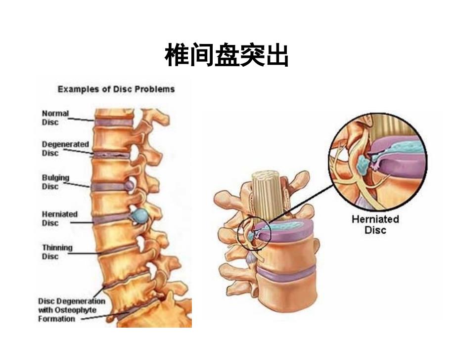 （腰椎间盘突出与腰肌劳损）运动康复课件_第4页