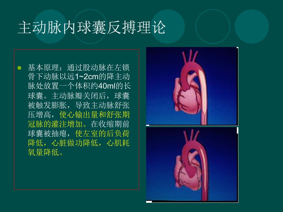 主动脉球囊反搏在心脏外科中课件_第4页