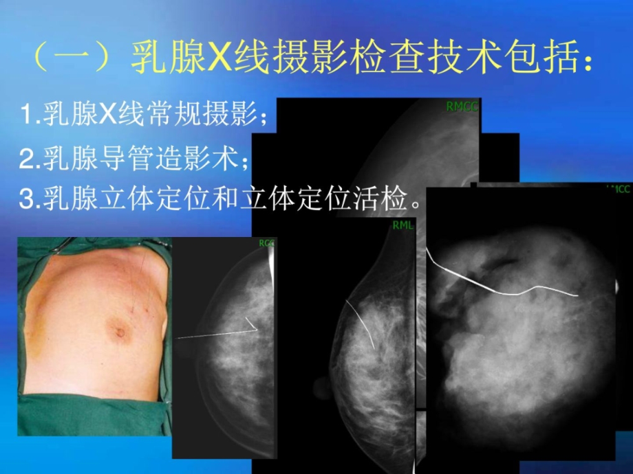 乳腺x线摄影及读片课件_第3页