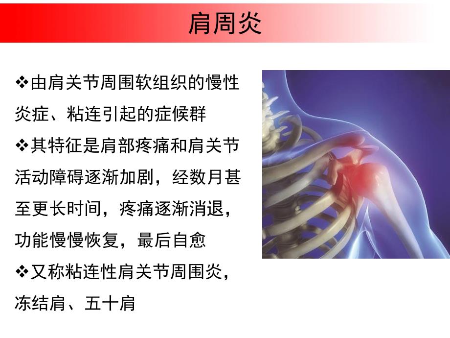 肩周炎 ppt课件_第2页