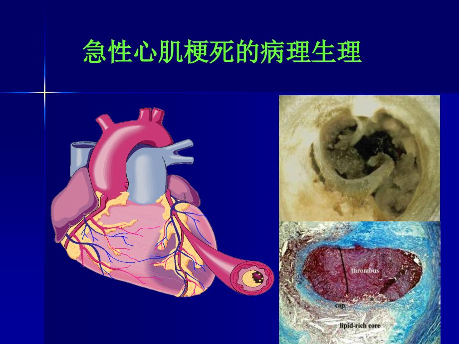 急性st段抬高心肌梗死溶栓治疗中国专家共识（2009年版）精品课件_第4页