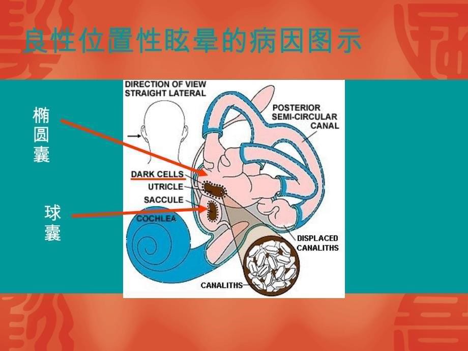 良性阵发性位置性眩晕手法复位课件_第5页