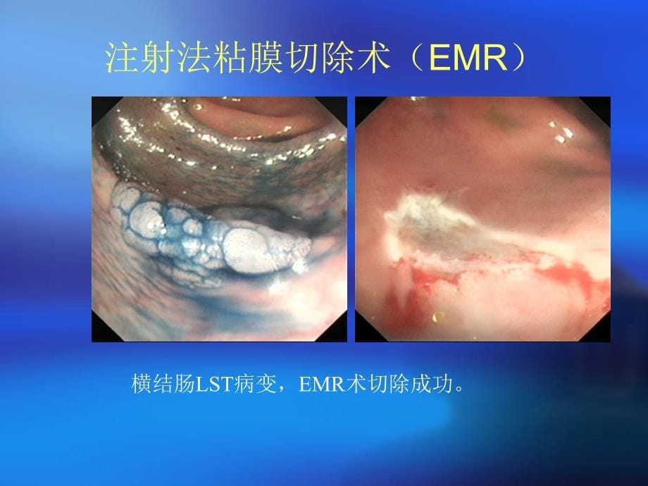 消化系统解剖及emr与esd（二）课件_第5页