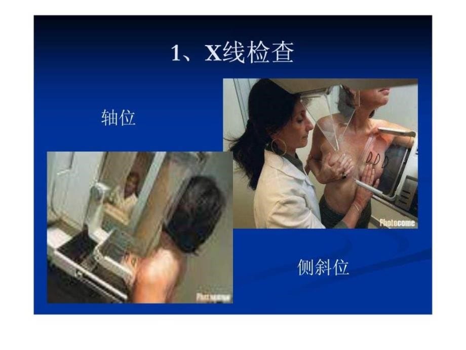 乳腺x线精品图片诊断课件_1_第5页