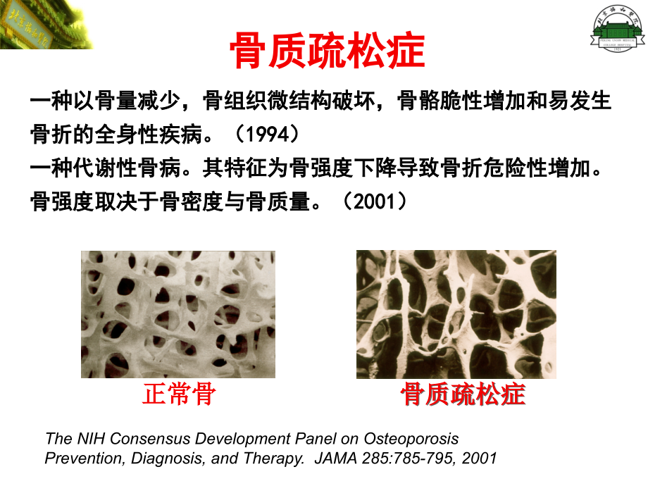 原发性骨质疏松症（修改）课件_第3页