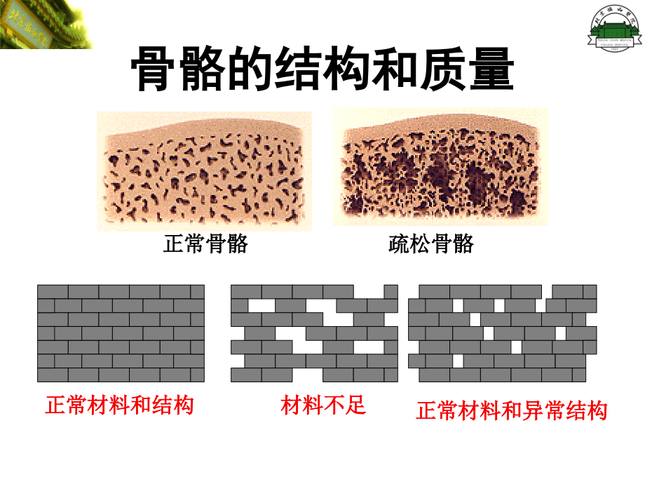 原发性骨质疏松症（修改）课件_第4页