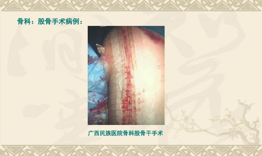 医学类手术示例骨科胸外科课件_第5页