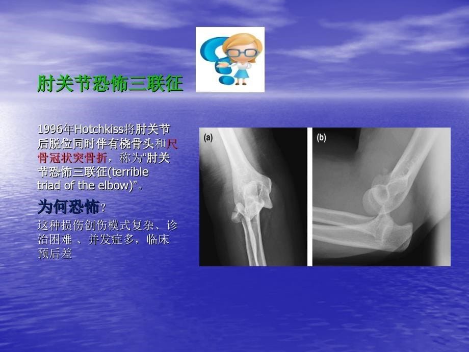 尺骨冠状突骨折护理查房PPT课件_第5页