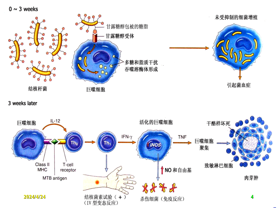 肺结核的ct诊断课件_1_第4页