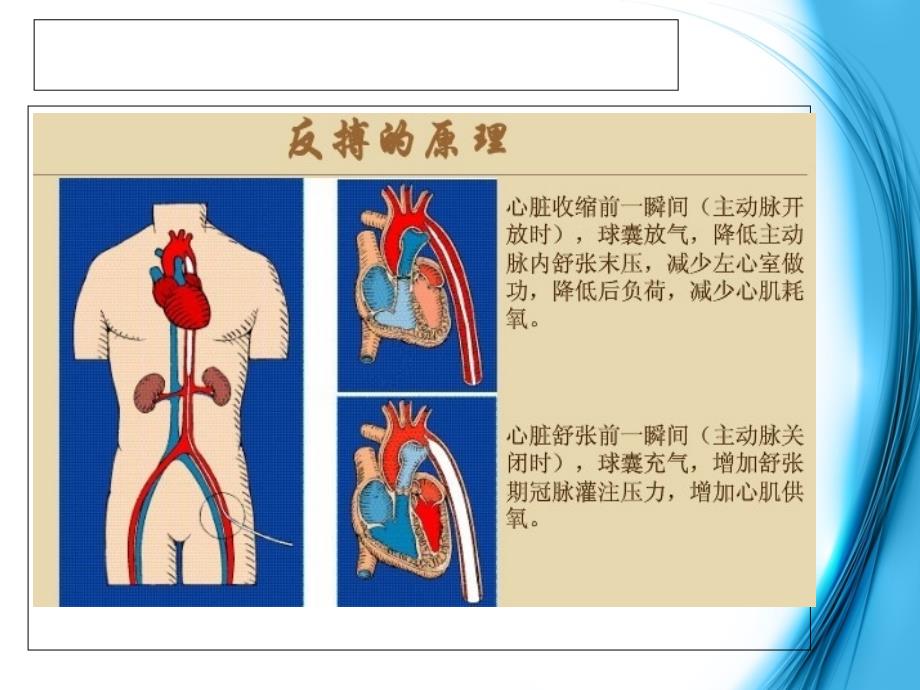 主动脉球囊反搏术护理资料课件_第4页