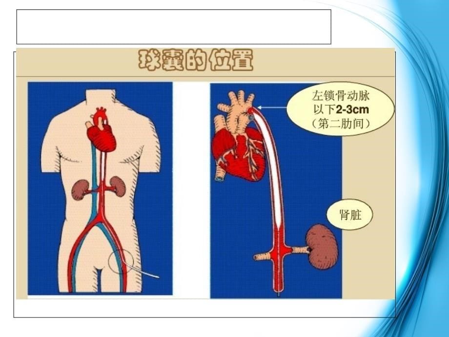 主动脉球囊反搏术护理资料课件_第5页