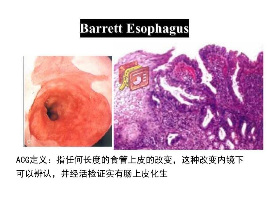 胃肠道的异型增生 病理变化和临床处理提示意义课件_第5页