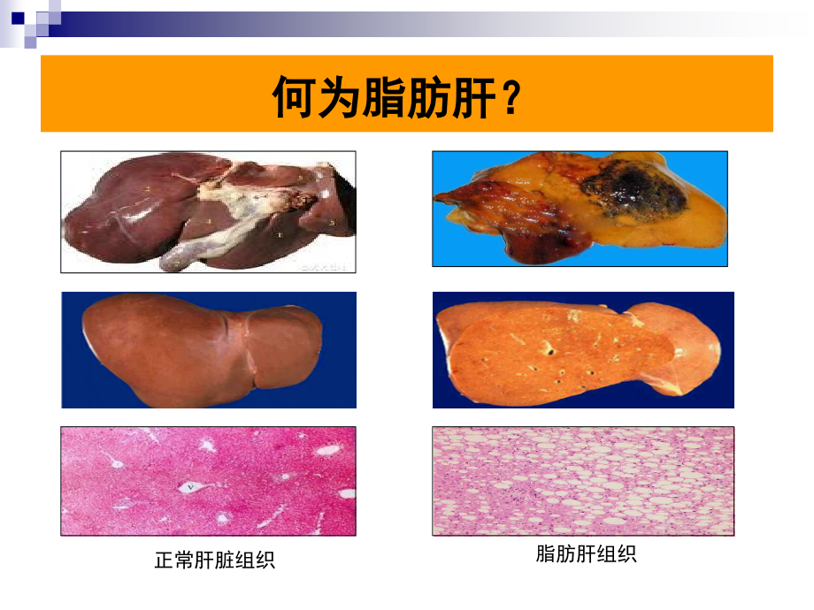 脂肪肝的诊治课件_第3页