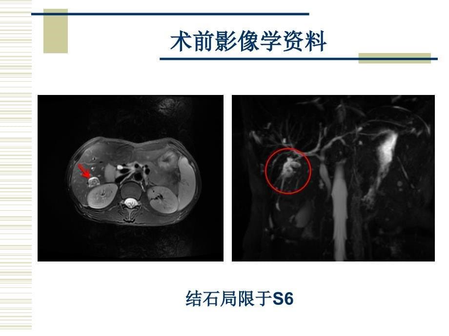 肝胆结石的几个难点问题课件_第5页