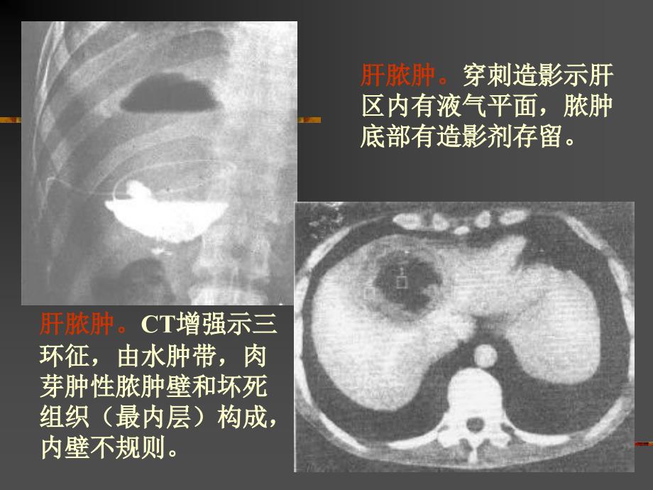 肝脓肿及其它病变课件_第4页