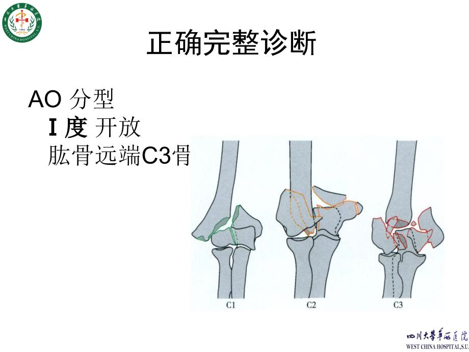 肱骨远端复杂骨折案例ppt课件_第4页