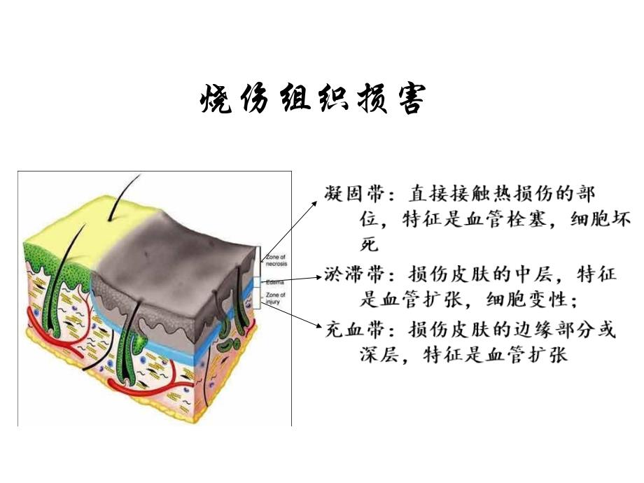 烧伤创面处理课件_第2页