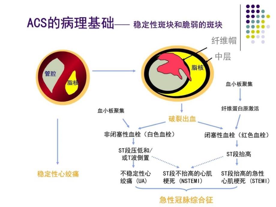 胸痛中心核心科室培训课件（急性冠脉综合征主动脉夹层_第4页