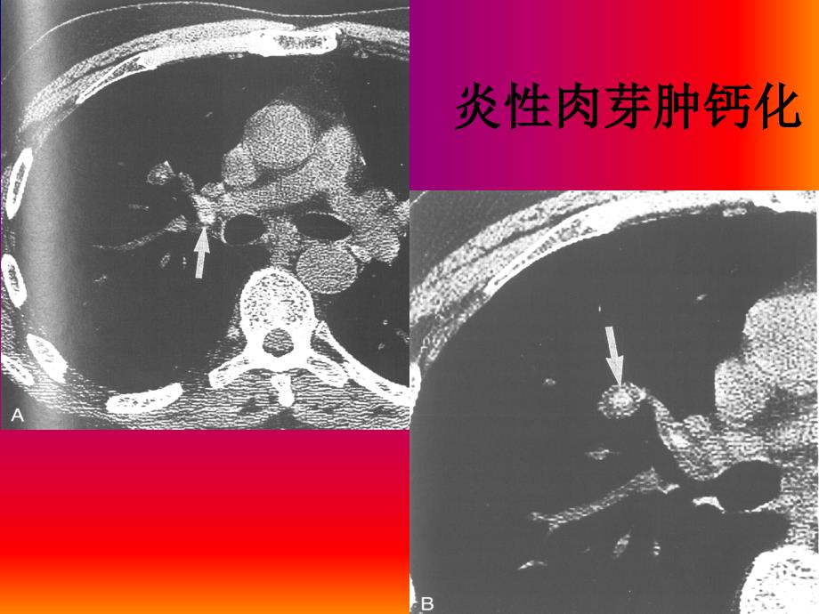 肺与纵隔影像诊断第三节基本病变的影像表现（二）课件_第4页