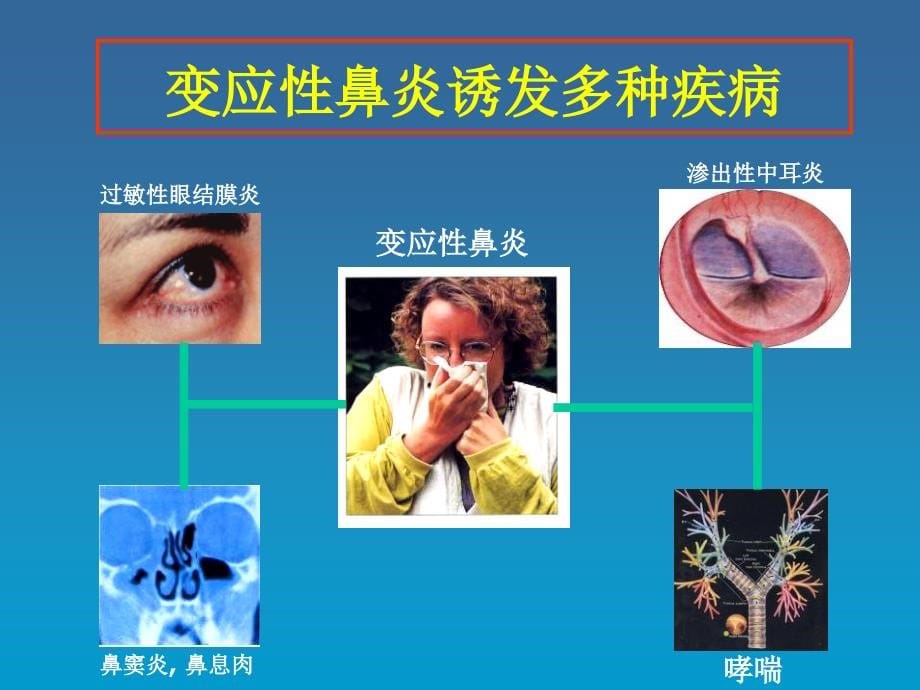 变应性鼻炎的再认识和进展课件_第5页