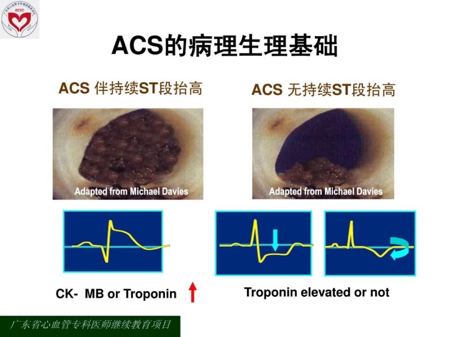 精华急性冠脉综合征的诊断与治疗向定成课件_第3页