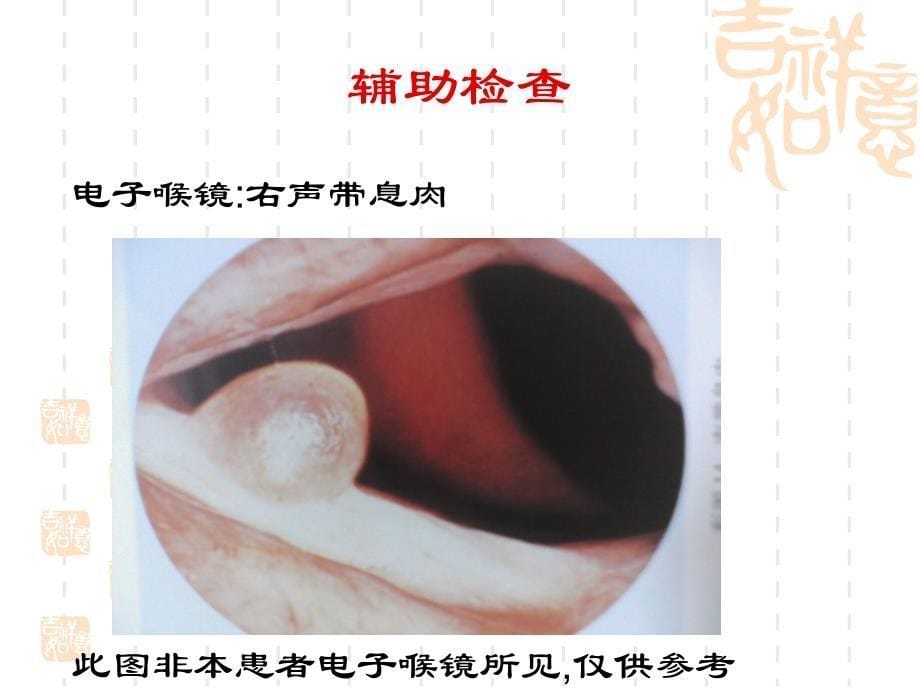 右声带息肉ppt课件_第5页