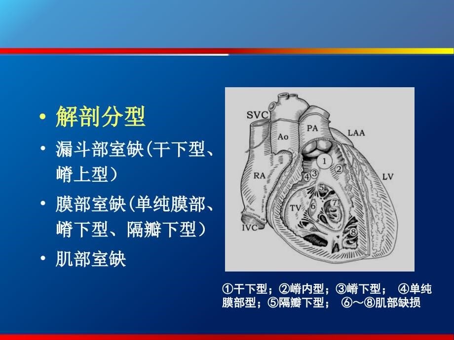 室间隔缺损的超声诊断课件_第5页