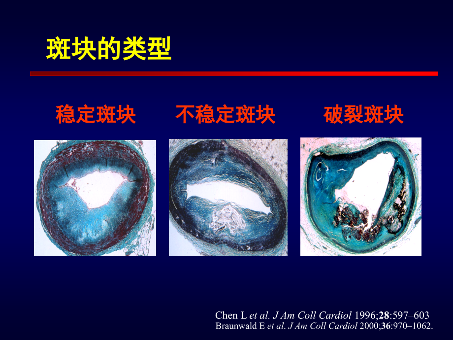 急性冠脉综合征的急诊处理课件_第4页