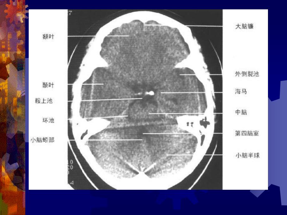 正常头颅 ct 及 mri 解剖课件_第4页