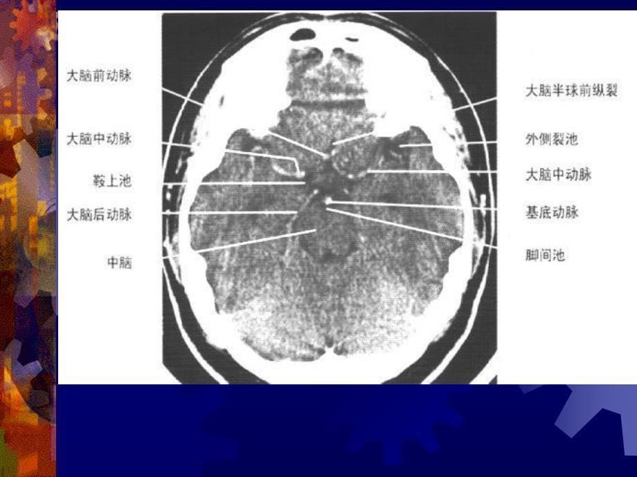 正常头颅 ct 及 mri 解剖课件_第5页